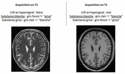 Pondération T1 et T2