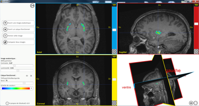 Recepteur D2 Dopamine 