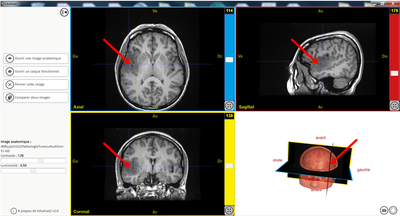 sujet12222PathologieTumeurAudition T1 HDPNG
