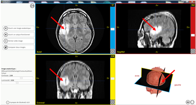 sujet12222PathologieTumeurAudition T2Flair
