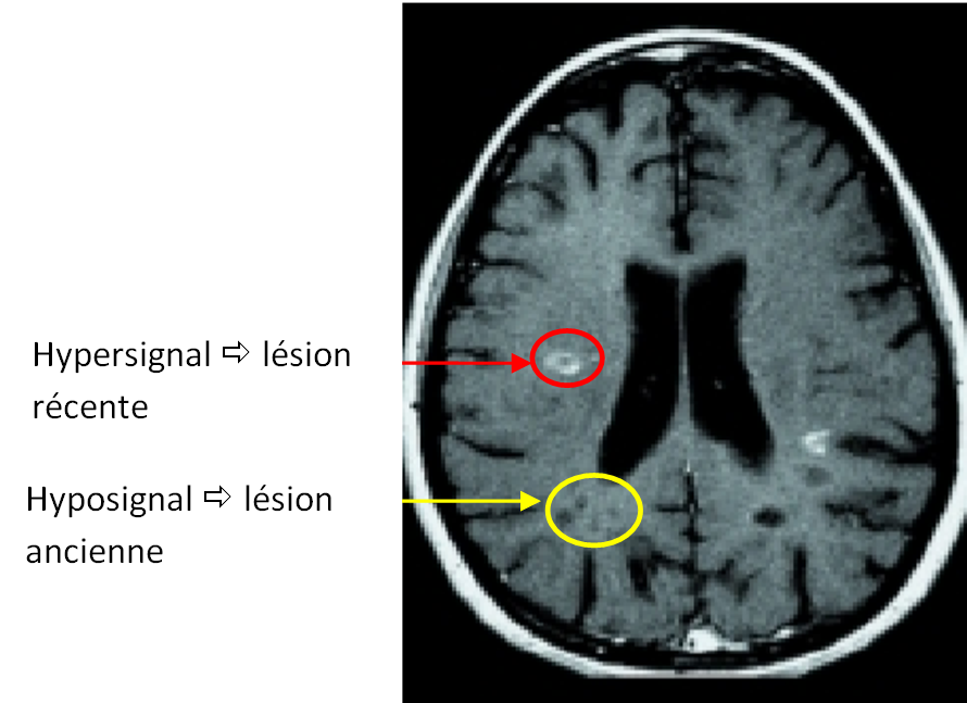 IRM cérébrales et médullaires pathologiques dans le cas d'une ...