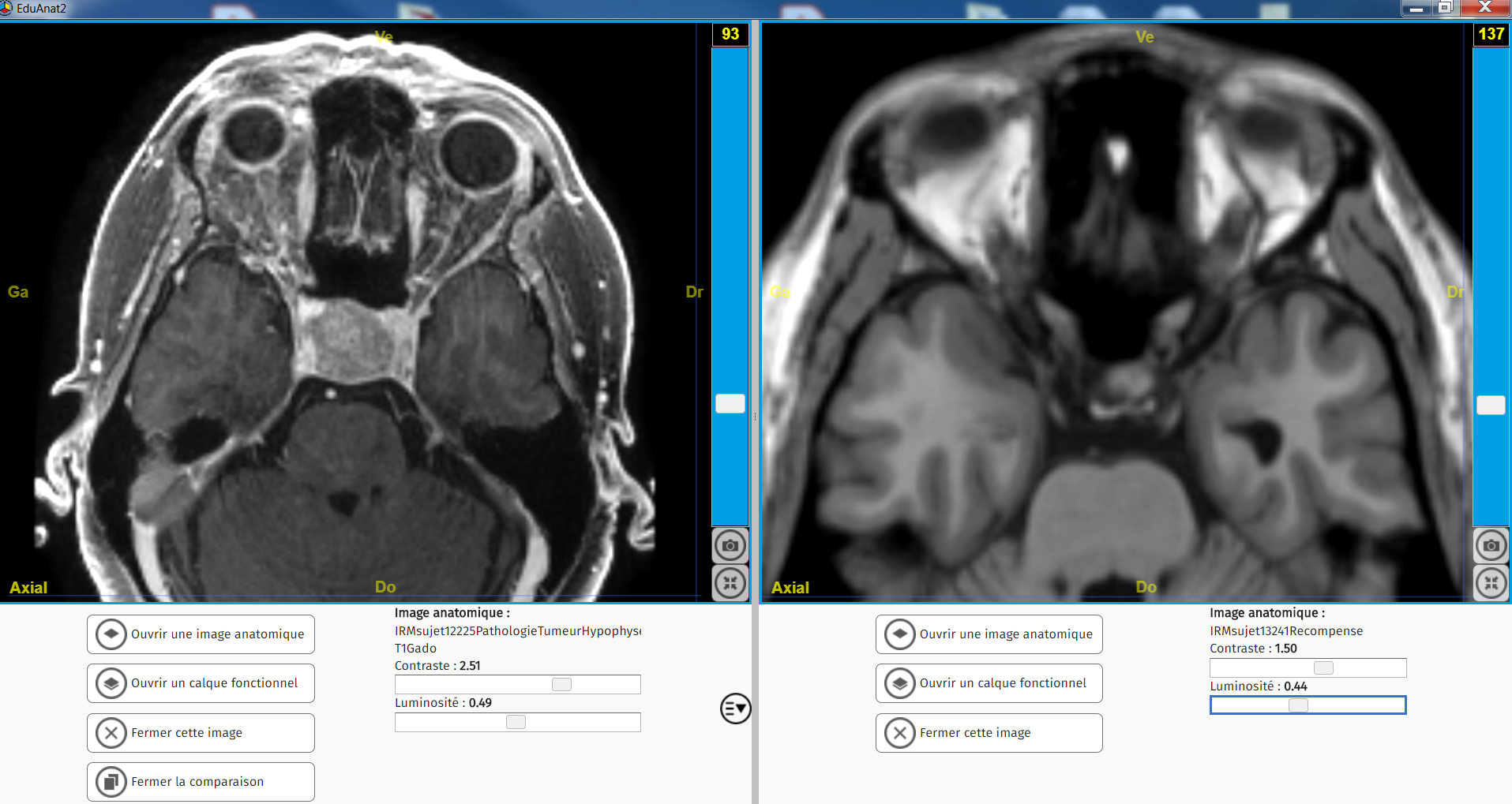 Tumeur hypophyse vision