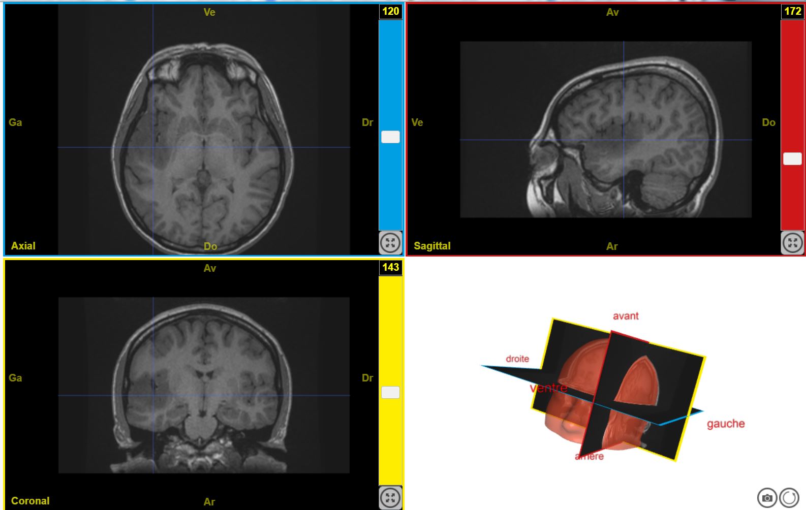 TumeurHallucinationAuditive T1