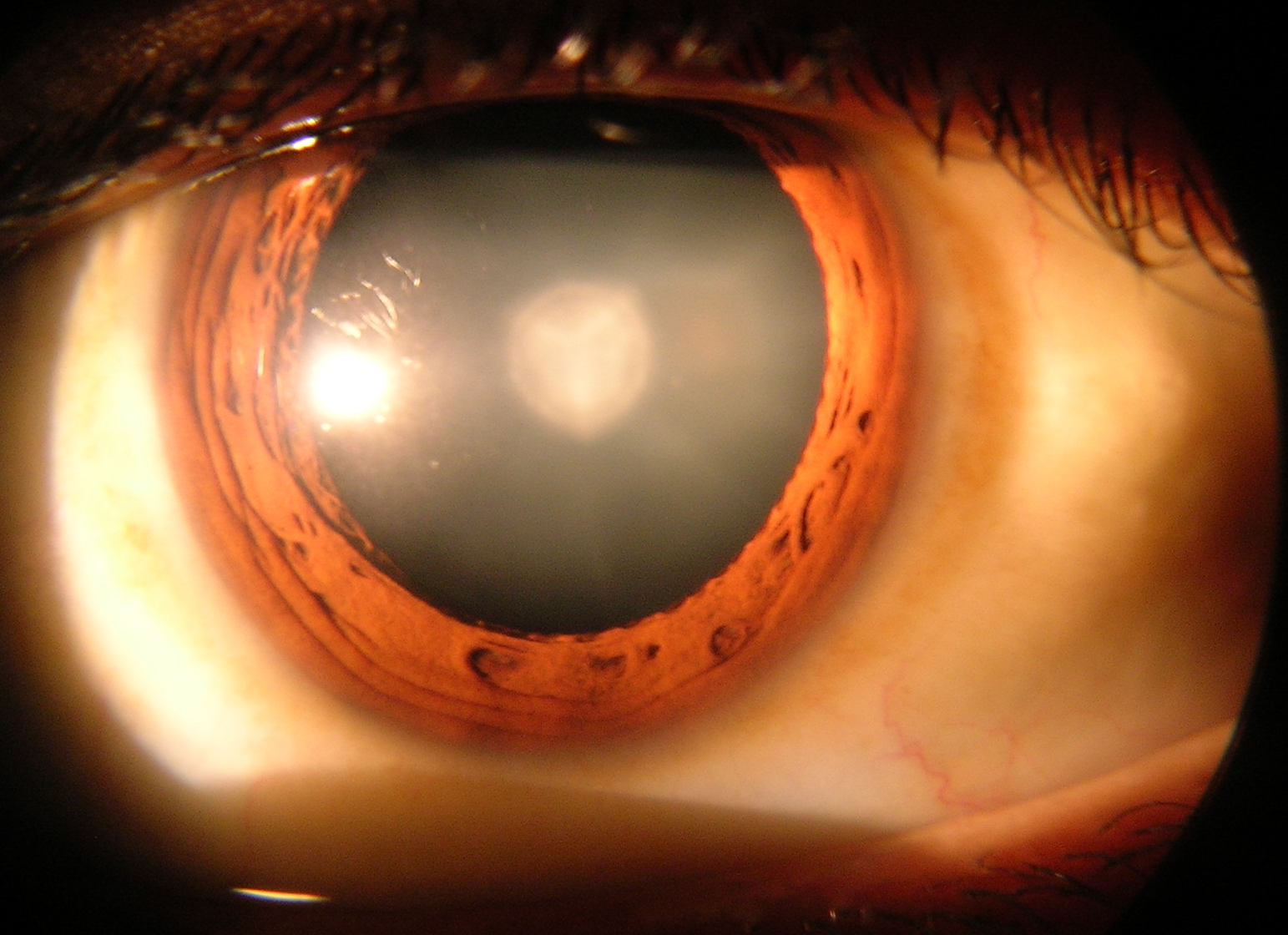 cataract-in-human-eye.png